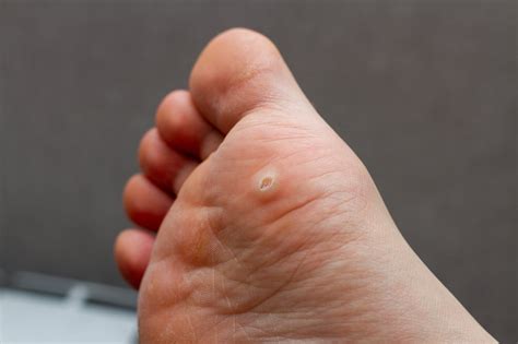 Plantar Warts In Adults And Children — Causes Treatment And Prevention