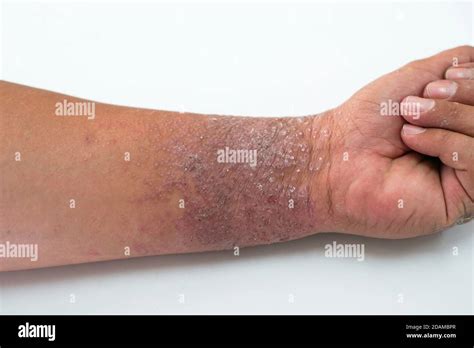 Eczema On A Mans Wrist Eczema Is An Inflammation Of The Skin That