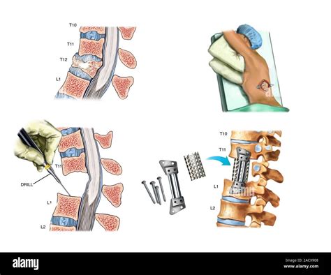 Surgery To Fuse The Thoracic Spine Artwork Sequence Illustrating