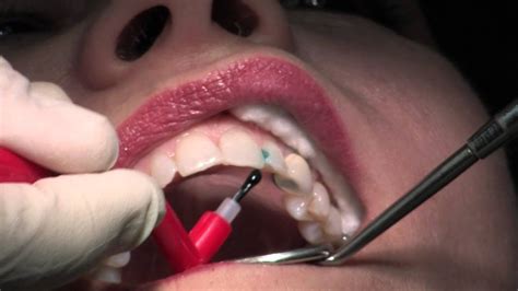 How Long Composite Fillings Last And Take Care Of It Tooth Colored