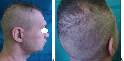 Clinical Aspect Diffuse Alopecia Involving The Scalp And The Eyebrows