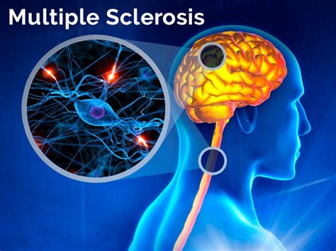 Multiple Sclerosis Causes Symptoms Diagnosis And Treatment