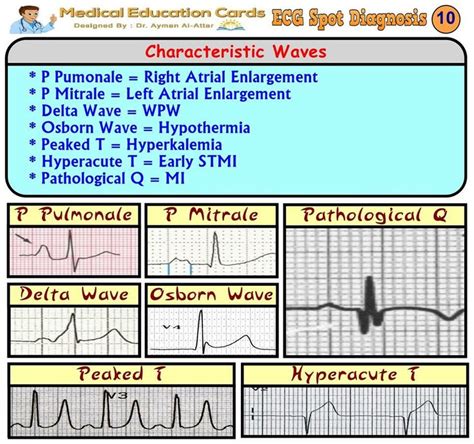 5 Lead Ecg Placement Mnemonic