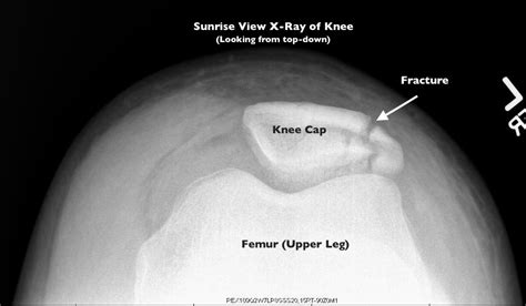 Patella Knee Cap Fracture