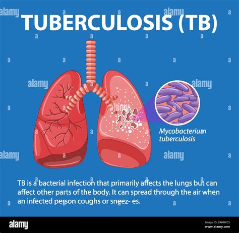 Tuberculosis Lungs Diagram