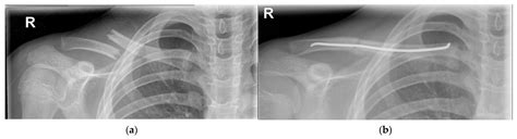 Children Free Full Text Pediatric Clavicle Fractures And Congenital