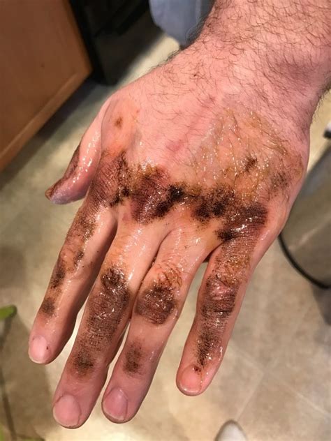 Coal tar is still used to treat a variety of skin disorders, particularly conditions where the skin is flaky and scaly. Removing Roof Tar from Skin with Olive Oil | ThriftyFun