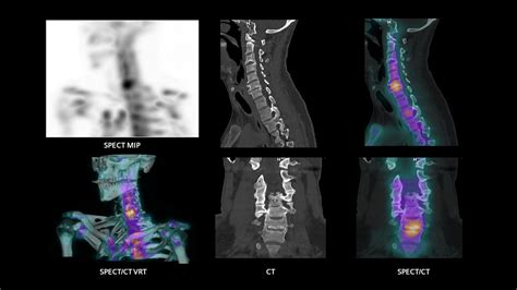 SPECT CT In Musculoskeletal Medicine Siemens Healthineers