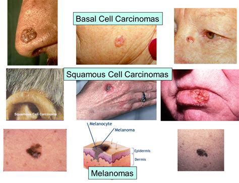 Depending on the specific parts of the body affected, the symptoms of metastatic breast cancer can vary. May: Skin Cancer - Maravilloso Magazine