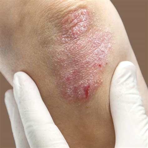 Types Of Skin Problems Types Of Skin Conditions Pictures Photos Images And Photos Finder