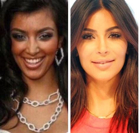 Kim Kardashian Before And After Nose Job