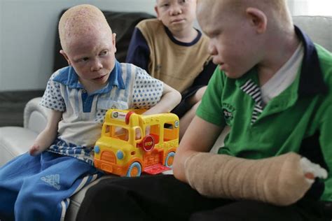 Charity Helps Albino Child Victims From Tanzania Get New Limbs