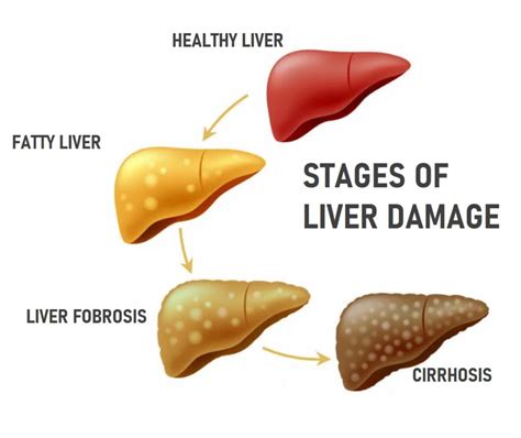 Non Alcoholic Fatty Liver Disease Dr Sachin Palnitkar