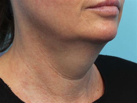 Coolsculpting And Exilis For Double Chin Non Invasive Neck Reduction