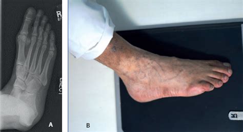 Radiology In Foot And Ankle Musculoskeletal Key