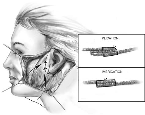 Rhytidectomy Pocket Dentistry