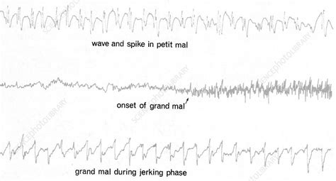Eeg Of Epileptic Seizures Stock Image C0075710 Science Photo Library