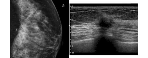 A Case Of Architectural Distortion On Mammography A Mammography