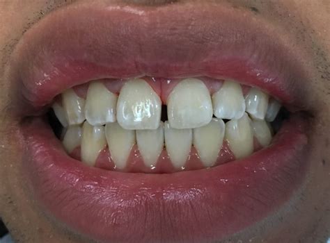 You could have your dentist do some quick bondings on the the front teeth to closing gaps in your teeth can be done with without orthodontics but the results never look as good without orthodontic treatment. Close Gap In Front Teeth In One Visit Without Braces ...