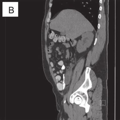 Ct Scan Shows Acute Appendicitis Dilated Fluid Filled Appendix