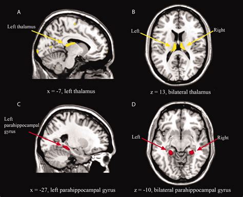 Changes In Regional Brain Morphology In Neuropsychiatric Systemic Lupus