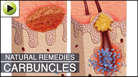 Home Remedies For Carbuncles Youtube