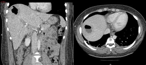Fungal Liver Abscess In An Immunocompetent Patient Who Underwent