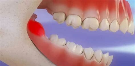 Causes of wisdom tooth pain. Wisdom Tooth Extraction In Singapore | No More Bugging Pain?