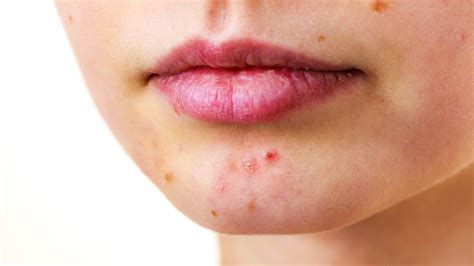 Heres Whats Really Causing The Acne On Your Chin