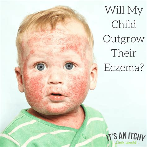 Will Your Child Outgrow Their Eczema A Dermatologists Perspective