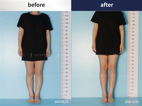 Achieve Height Growth With Leg Lengthening Surgery