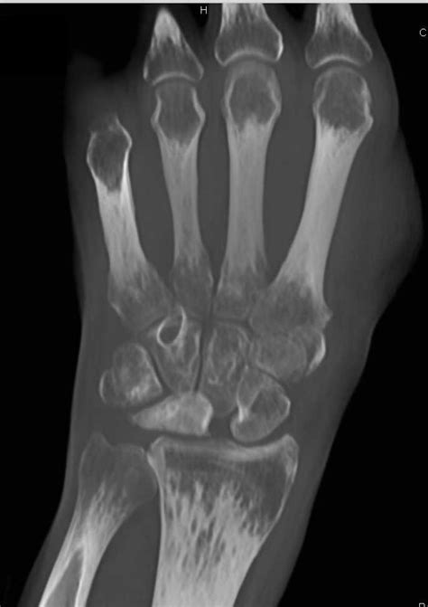 Fracture And Subsequent Avascular Necrosis Lunate Musculoskeletal
