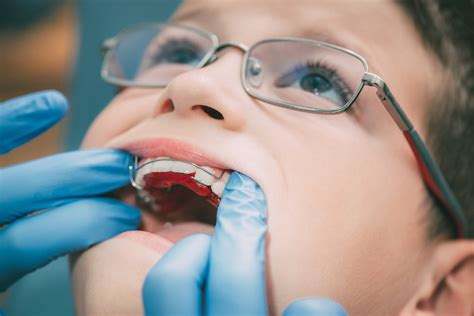 Interceptive Orthodontics Smiles On Queen Dentistry Orthodontics In