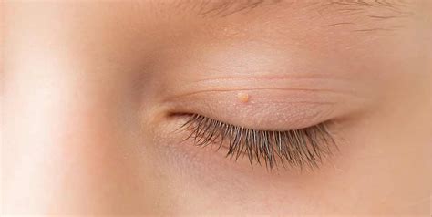 Eyelid Lump Diagnosis And Removal London Miss Elizabeth Hawkes