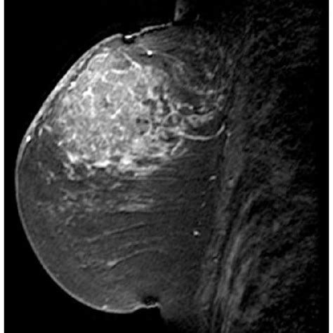 Left A Ct Breast Image Right The Ideal Partition Hand Made And