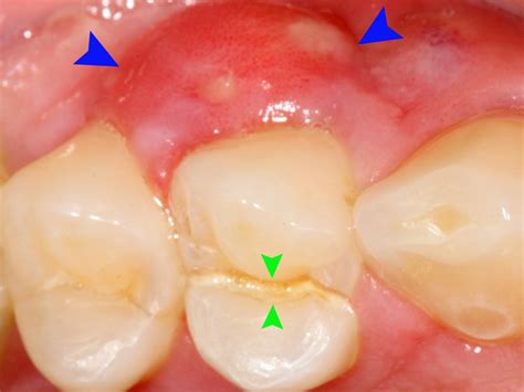 Bump On Gums Causes And How To Treat Them