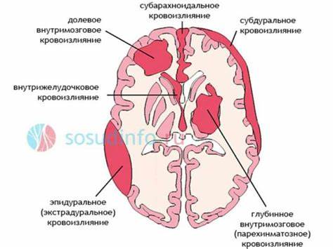 Геморрагический инсульт диета Острое нарушение мозгового кровообращения. Геморрагический инсульт Острое нарушение мозгового кровообращения. Геморрагический инсульт Геморрагический инсульт диета