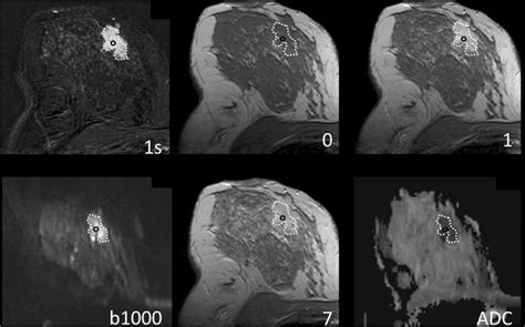 Diffusion Weighted Imaging Can Streamline Breast Mri Physics World