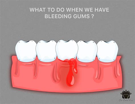 What Do You Do When Your Gums Are Bleeding Elite Dental Care