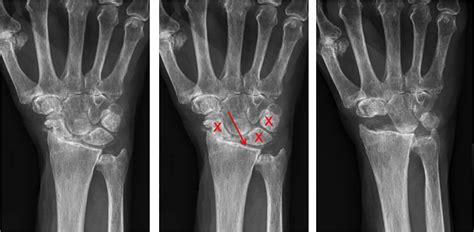 Wrist Arthritis Raleigh Hand Surgery — Joseph J Schreiber Md