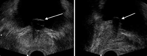 Transrectal Ultrasound Showing The Midline Prostatic Cyst Located