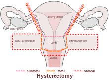 Having Sex After A Hysterectomy