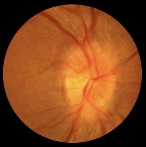 Pain On Eye Movement Paddy Kalish Od Optometrist