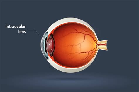 What Is An Intraocular Lens Clinica London