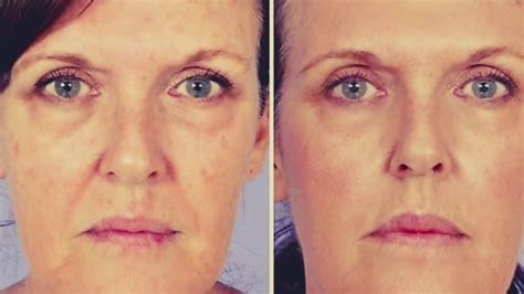 Dermapen Microneedling De Mooiste Voor En Na Foto S Youtube