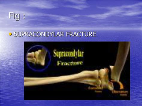 Ppt Supracondylar Fracture Powerpoint Presentation Free Download