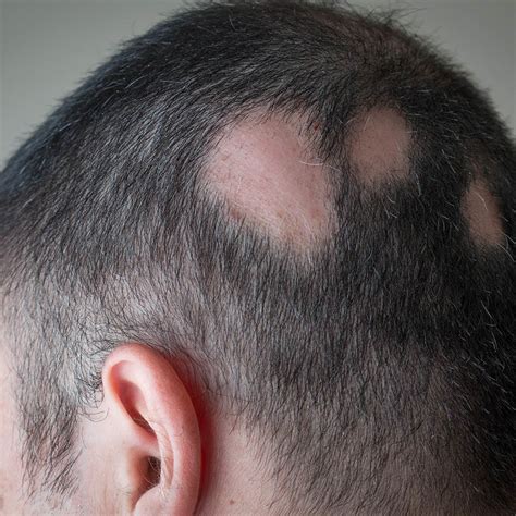 Alopecia Areata Causas Sintomas E Tratamento Dermatologia Em Joinville Juliana Campos