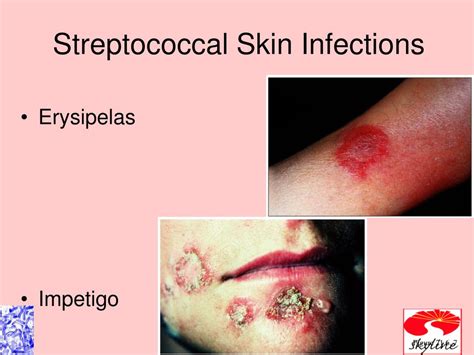 Ppt Disease Of Skin And Eyes Ch 21 Powerpoint Presentation Free