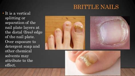 Disorders Of Nails Ppt Nail Ftempo