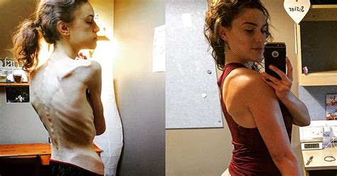 Duras Im Genes Del Antes Y Despu S De Una Sobreviviente De Anorexia Instagram Le Salv La Vida